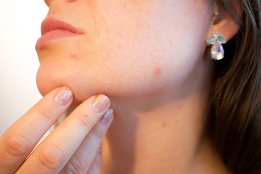 Des difficultés avec les cicatrices dues à l’acné?